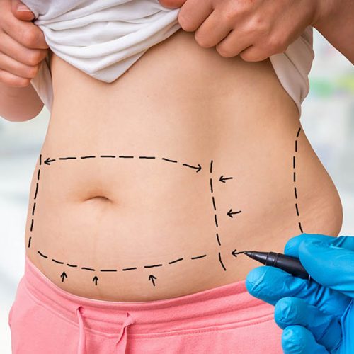 tummy tuck abdominoplasty claims